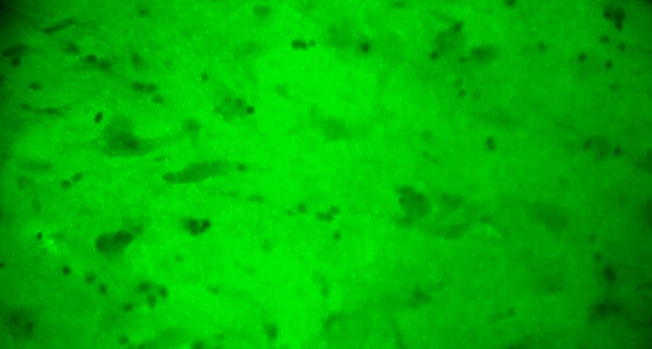 神經(jīng)系統(tǒng)非腫瘤性疾病