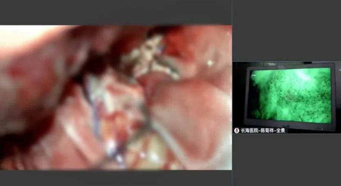 復(fù)發(fā)膠質(zhì)瘤治療新曙光 長海醫(yī)院應(yīng)用細(xì)胞級熒光導(dǎo)引技術(shù)實(shí)現(xiàn)最大化安全切除