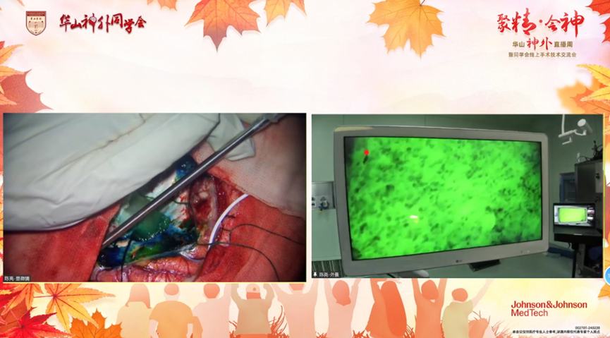 癲癇病灶細(xì)胞級精準(zhǔn)手術(shù)成功開展,手術(shù)邁入新時代(圖1)