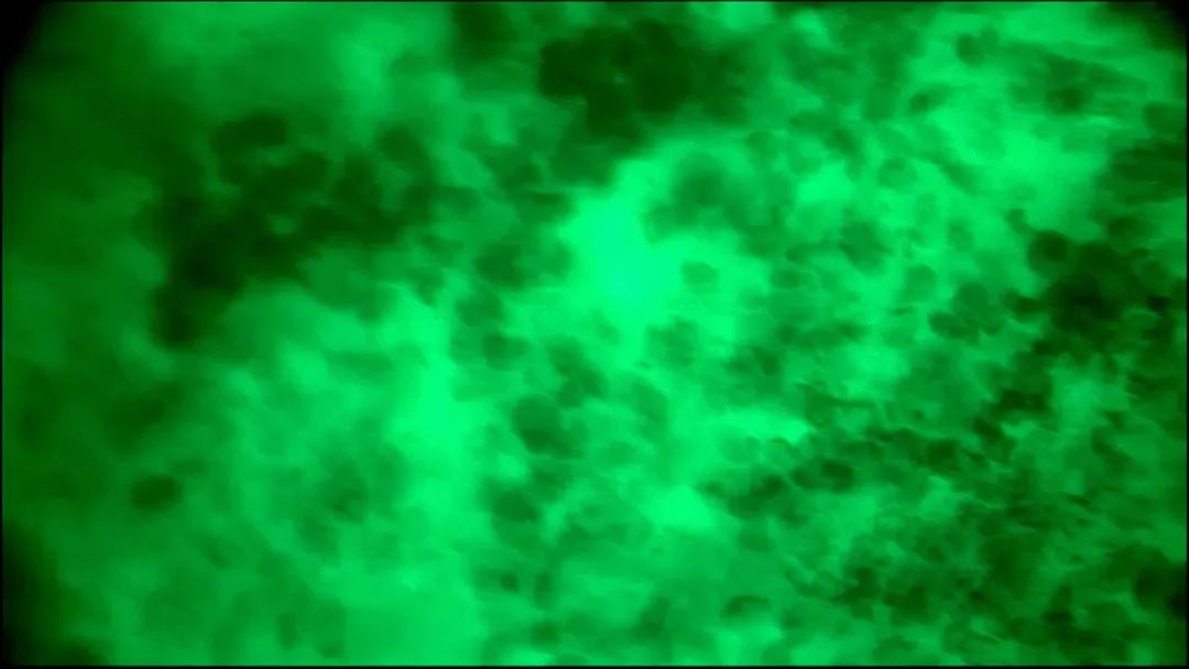 EndoScell?術(shù)中手持顯微鏡助力腦轉(zhuǎn)移瘤細(xì)胞級精準(zhǔn)手術(shù)，最大化安全切除(圖5)