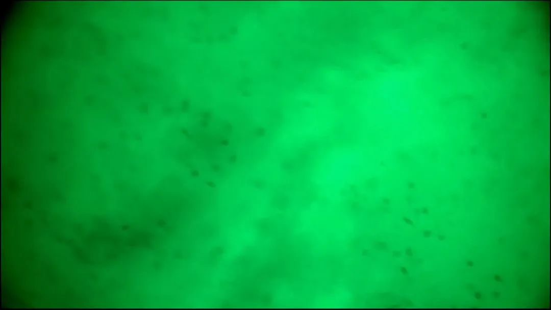 EndoScell?術(shù)中手持顯微鏡助力腦轉(zhuǎn)移瘤細(xì)胞級精準(zhǔn)手術(shù)，最大化安全切除(圖6)