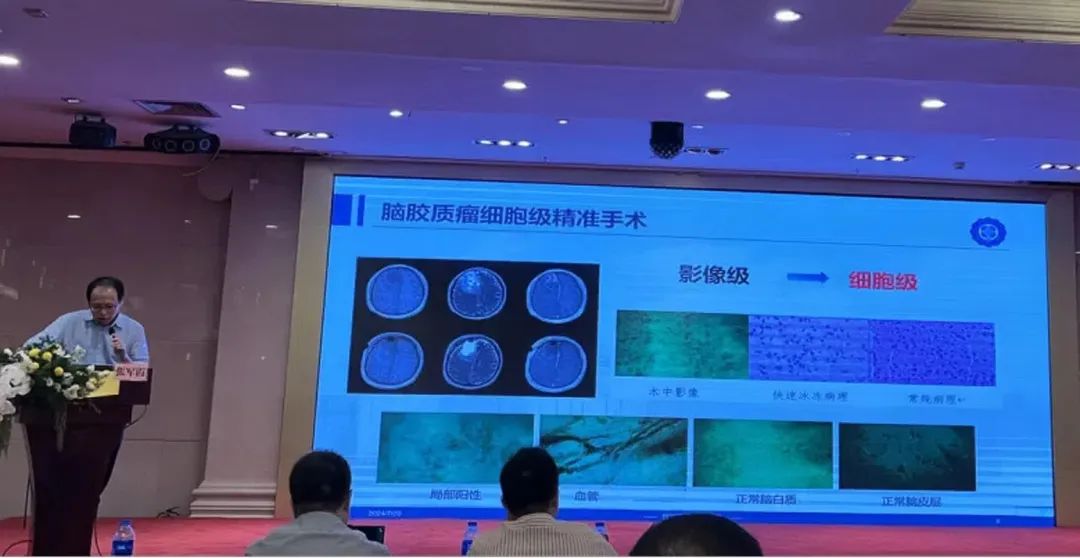 術中手持顯微鏡EndoSCell?助推腦膠質瘤診療進入細胞級精準手術時代(圖5)