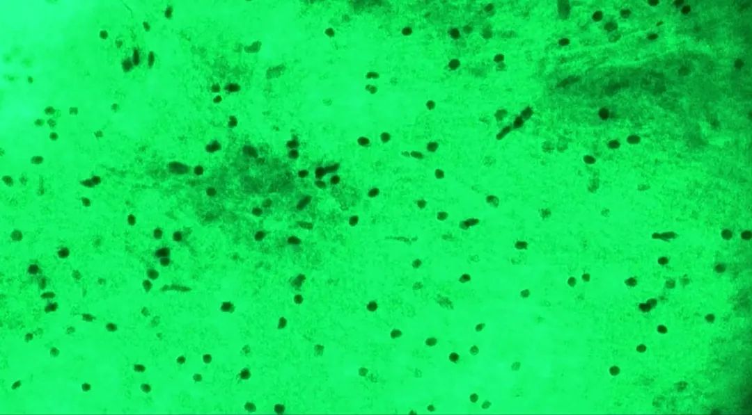 河北醫(yī)大二院應(yīng)用細(xì)胞級(jí)熒光導(dǎo)引精準(zhǔn)技術(shù)，突破高級(jí)別膠質(zhì)瘤手術(shù)的裸眼限制(圖10)