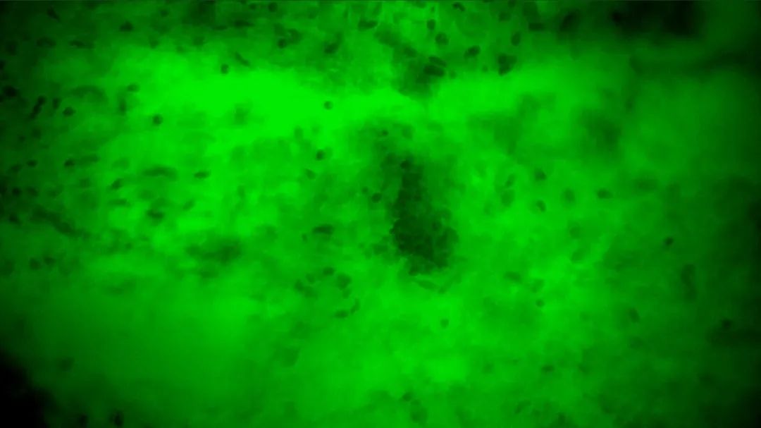 齊魯醫(yī)院開啟精準(zhǔn)手術(shù)新篇章，細(xì)胞級熒光導(dǎo)引技術(shù)助力腦膠質(zhì)瘤最大化安全切除(圖6)