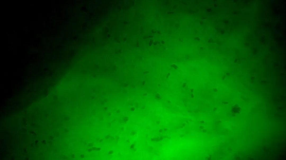 齊魯醫(yī)院開啟精準(zhǔn)手術(shù)新篇章，細(xì)胞級熒光導(dǎo)引技術(shù)助力腦膠質(zhì)瘤最大化安全切除(圖7)