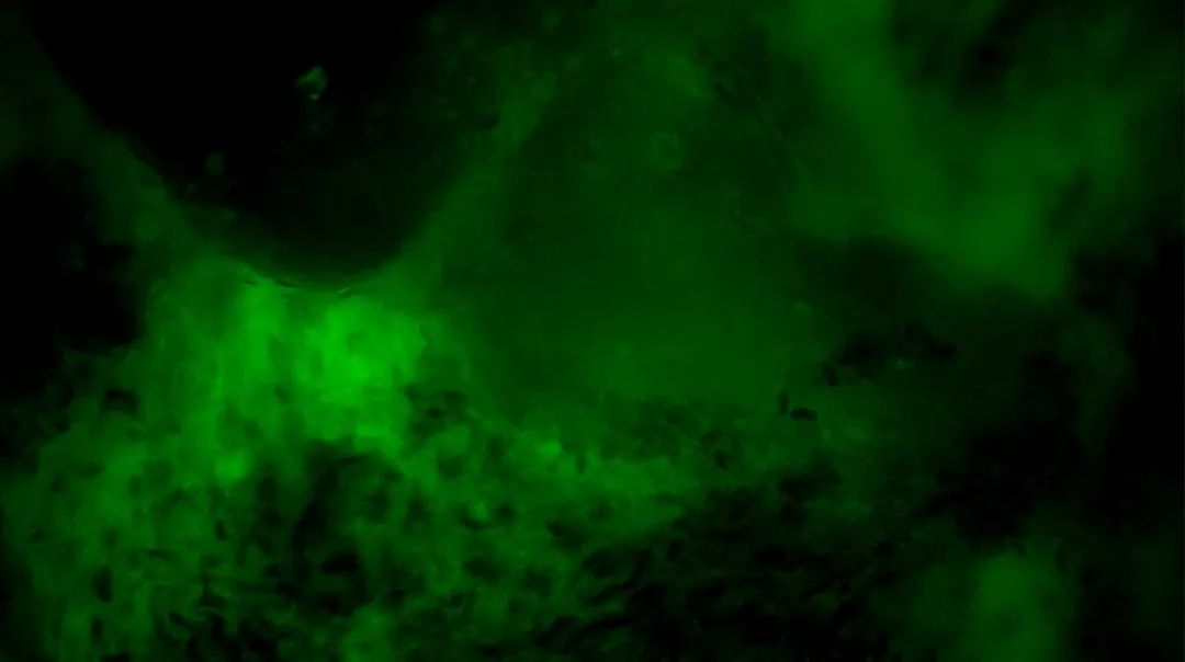 齊魯醫(yī)院開啟精準(zhǔn)手術(shù)新篇章，細(xì)胞級(jí)熒光導(dǎo)引技術(shù)助力腦膠質(zhì)瘤最大化安全切除(圖5)