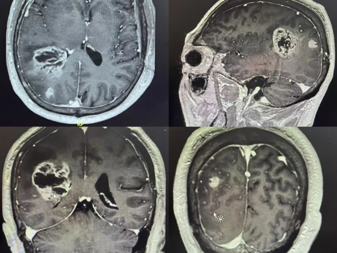 齊魯醫(yī)院開啟精準(zhǔn)手術(shù)新篇章，細(xì)胞級(jí)熒光導(dǎo)引技術(shù)助力腦膠質(zhì)瘤最大化安全切除(圖3)