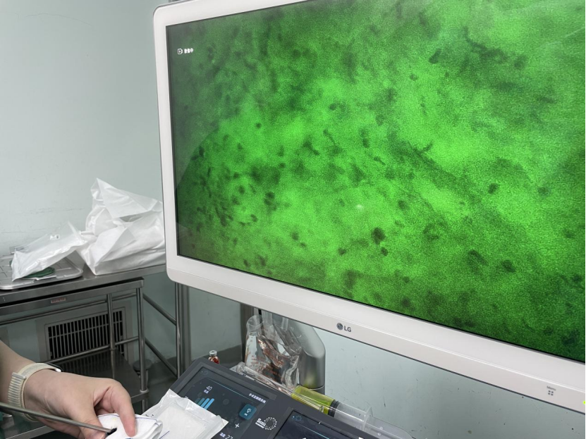 國內首例！齊魯醫(yī)院應用細胞級顯微鏡同步術中快速分子病理診斷指導膠質瘤精準切除(圖2)