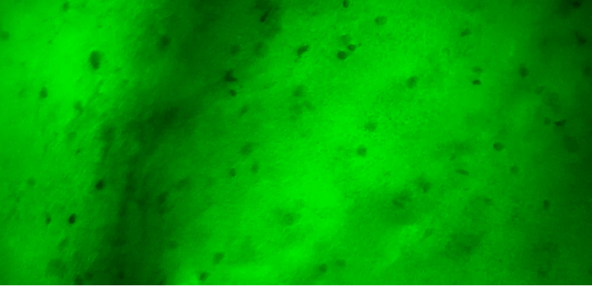 國內(nèi)首例！齊魯醫(yī)院應用細胞級顯微鏡同步術中快速分子病理診斷指導膠質瘤精準切除(圖4)