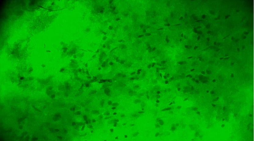 膠質(zhì)母細(xì)胞瘤手術(shù)新突破:河北醫(yī)大二院應(yīng)用EndoSCell?實(shí)現(xiàn)細(xì)胞級精準(zhǔn)切除(圖5)