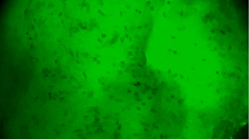 膠質(zhì)母細(xì)胞瘤手術(shù)新突破:河北醫(yī)大二院應(yīng)用EndoSCell?實(shí)現(xiàn)細(xì)胞級(jí)精準(zhǔn)切除(圖6)