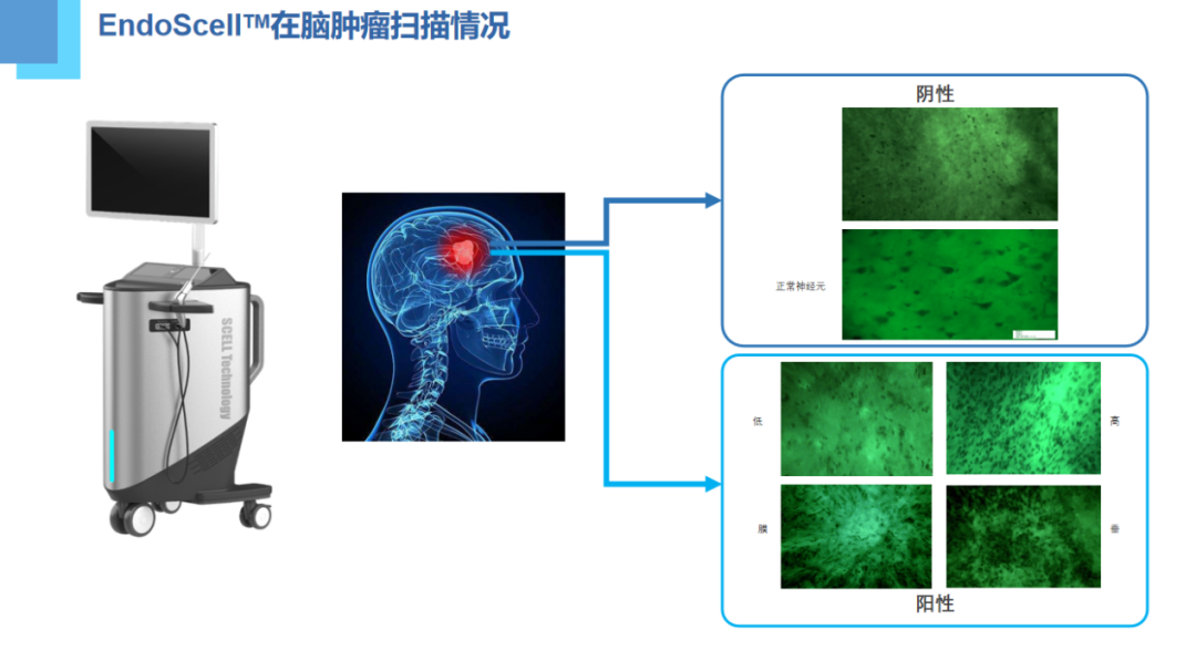 第八屆華福神經(jīng)外科學(xué)術(shù)會(huì)議:EndoSCell?細(xì)胞級(jí)熒光導(dǎo)引技術(shù)獲專家認(rèn)可(圖3)