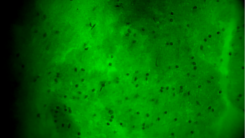 天津首例！天津市環(huán)湖醫(yī)院應(yīng)用細(xì)胞級熒光導(dǎo)引技術(shù)精準(zhǔn)切除高級別膠質(zhì)瘤(圖8)