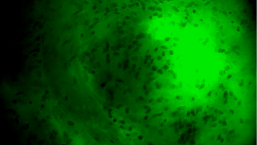 天津首例！天津市環(huán)湖醫(yī)院應(yīng)用細(xì)胞級熒光導(dǎo)引技術(shù)精準(zhǔn)切除高級別膠質(zhì)瘤(圖7)