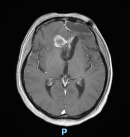天津首例！天津市環(huán)湖醫(yī)院應(yīng)用細(xì)胞級熒光導(dǎo)引技術(shù)精準(zhǔn)切除高級別膠質(zhì)瘤(圖4)