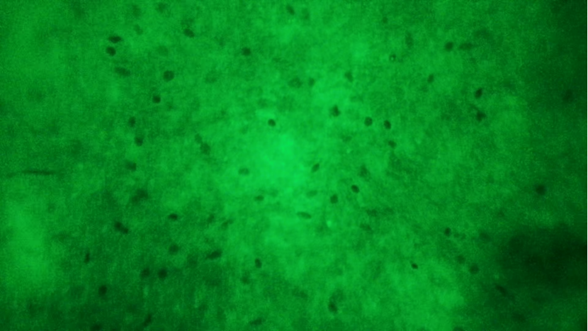 天津首例！天津市環(huán)湖醫(yī)院應(yīng)用細(xì)胞級熒光導(dǎo)引技術(shù)精準(zhǔn)切除高級別膠質(zhì)瘤(圖9)