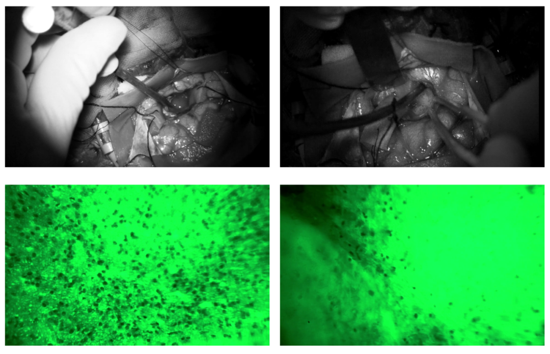 這項新技術(shù)加持，南方醫(yī)科大學珠江醫(yī)院專家“細胞級切除”微小腫瘤(圖3)