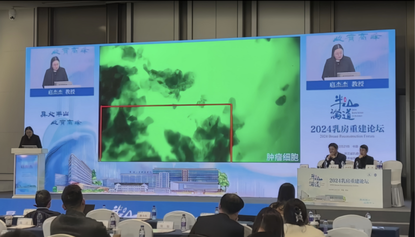 杭州乳房重建論壇:細胞級熒光導引技術(shù)EndoSCell?為保乳術(shù)精準切除保駕護航(圖4)