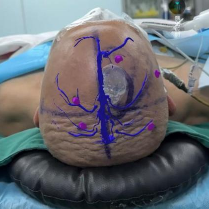 細胞級精準切除！河北醫(yī)大二院應用EndoSCell?實現膠質瘤手術新突破(圖6)