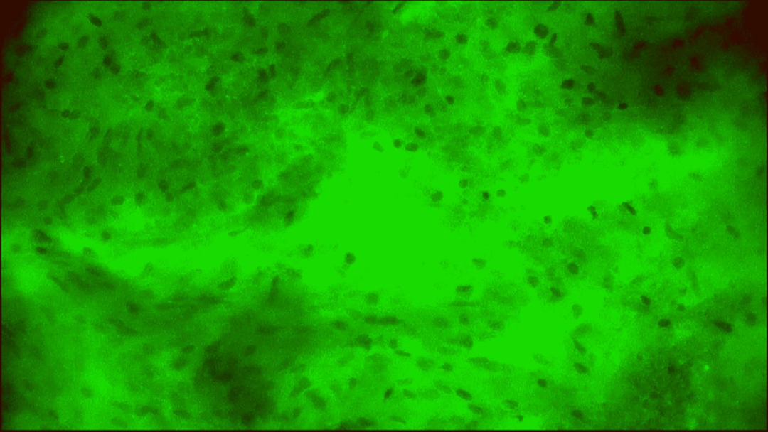 細胞級精準切除！河北醫(yī)大二院應用EndoSCell?實現膠質瘤手術新突破(圖8)