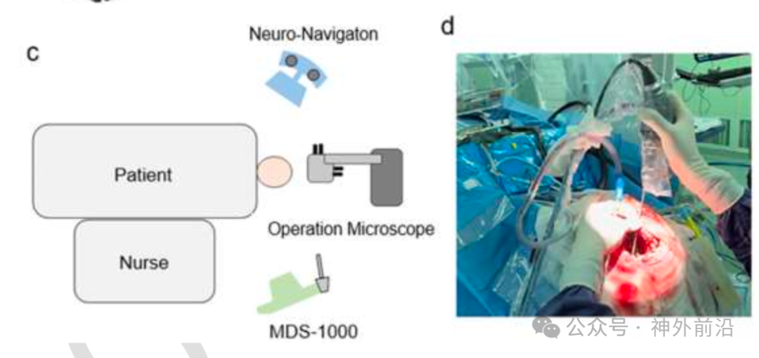 學(xué)術(shù)動(dòng)態(tài) | 華山神外團(tuán)隊(duì)報(bào)道膠質(zhì)瘤術(shù)中應(yīng)用手持病理顯微鏡輔助 可更精準(zhǔn)識(shí)別切除邊緣(圖3)