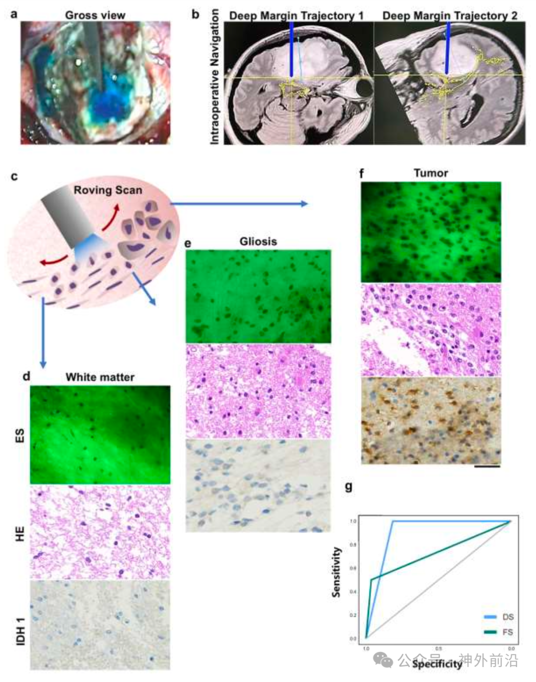 學(xué)術(shù)動(dòng)態(tài) | 華山神外團(tuán)隊(duì)報(bào)道膠質(zhì)瘤術(shù)中應(yīng)用手持病理顯微鏡輔助 可更精準(zhǔn)識(shí)別切除邊緣(圖4)