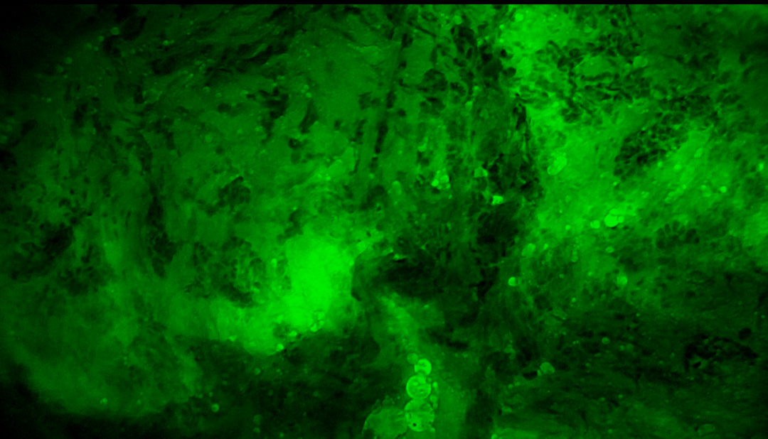 中國科大附一院開啟乳腺癌治療新篇章:細胞級熒光導引技術助力精準保乳術(圖3)