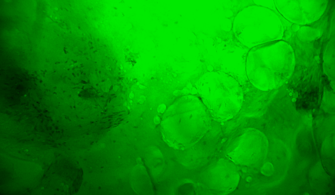 中國科大附一院開啟乳腺癌治療新篇章:細胞級熒光導引技術助力精準保乳術(圖4)