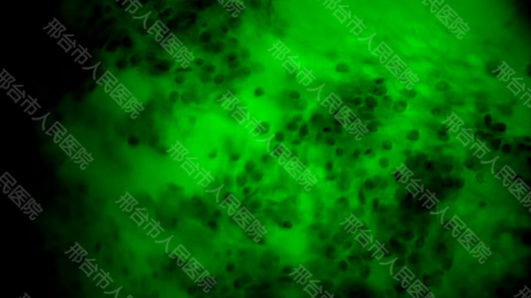 腦惡性腫瘤手術治療新進展！邢臺市人民醫(yī)院應用術中細胞級熒光導引技術最大化安全切除腦膠質瘤(圖4)