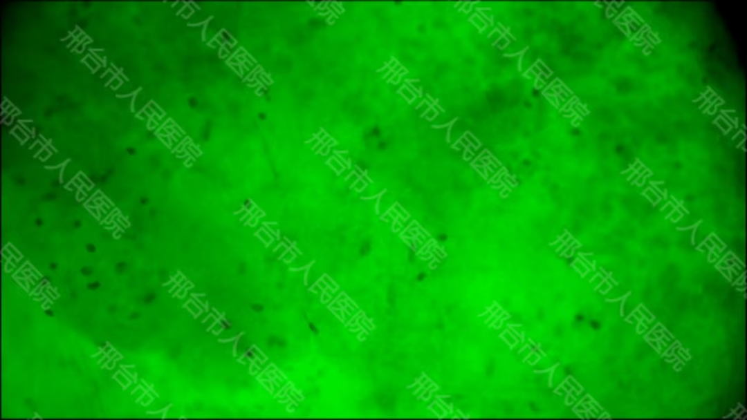 腦惡性腫瘤手術治療新進展！邢臺市人民醫(yī)院應用術中細胞級熒光導引技術最大化安全切除腦膠質瘤(圖5)