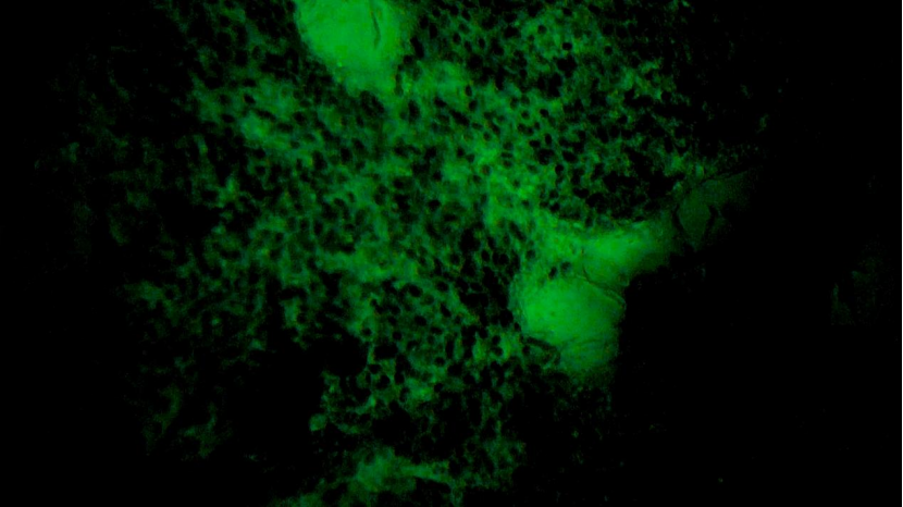 甲狀腺癌手術(shù)新突破！河北省人民醫(yī)院成功應(yīng)用細胞級熒光導引技術(shù)實現(xiàn)精準切除與保功能(圖3)