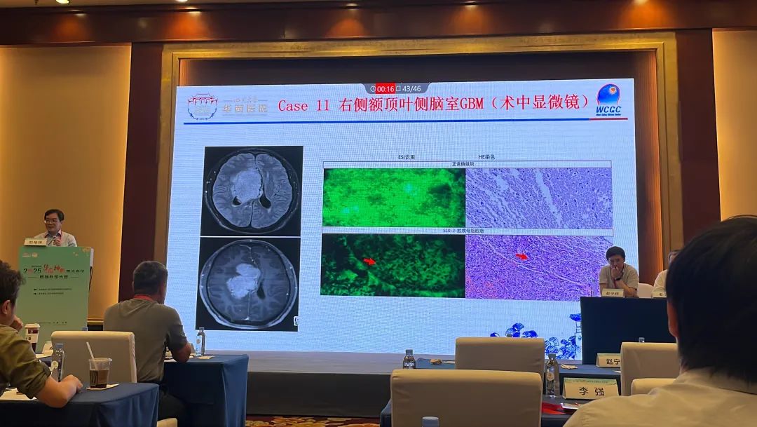 1200倍+放大直視腫瘤細胞！全球首創(chuàng)細胞級熒光導引技術(shù)EndoSCell?亮相華西神外學術(shù)周(圖5)